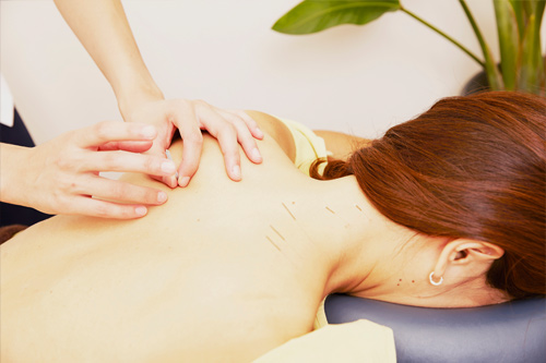 Acupuncture Treatment